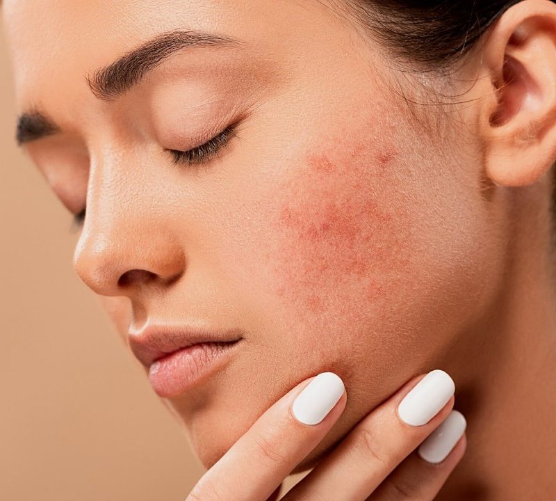 mitos sobre el acné