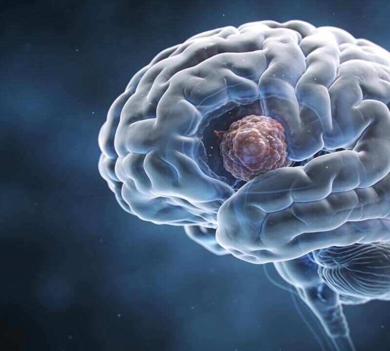 Las infusiones que podrían ayudar a prevenir un tumor cerebral