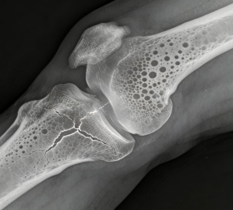 Medicamentos para la osteoporosis