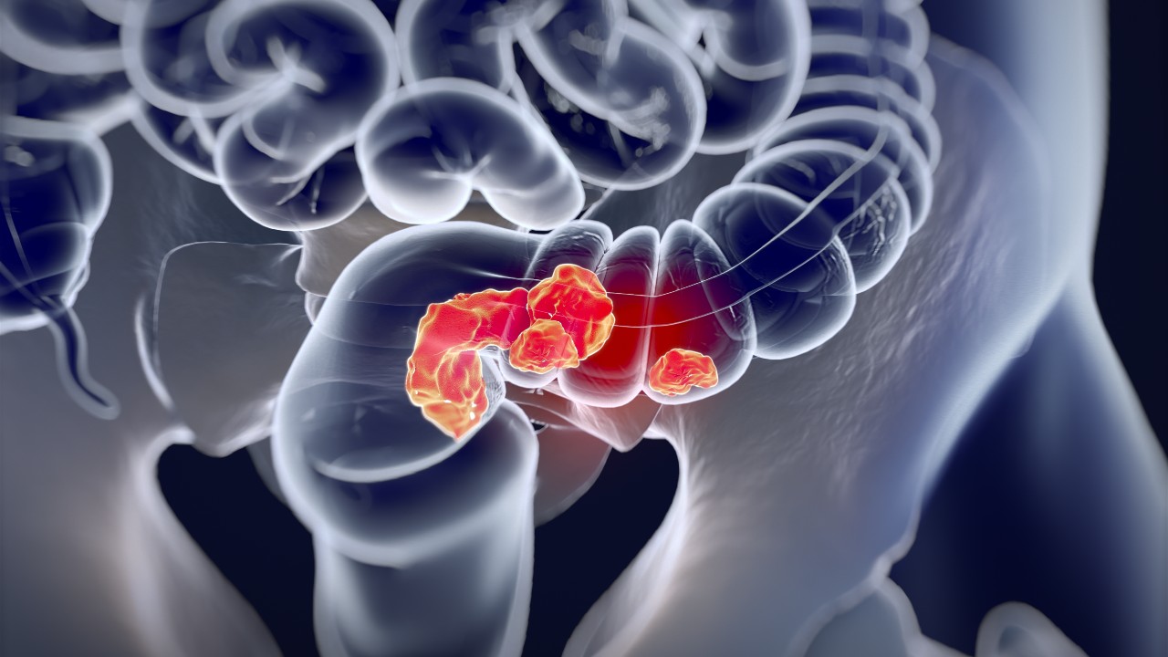 Examen de Mayo Clinic apunta hacia síndrome de Lynch, que es factor de riesgo para cáncer de colon