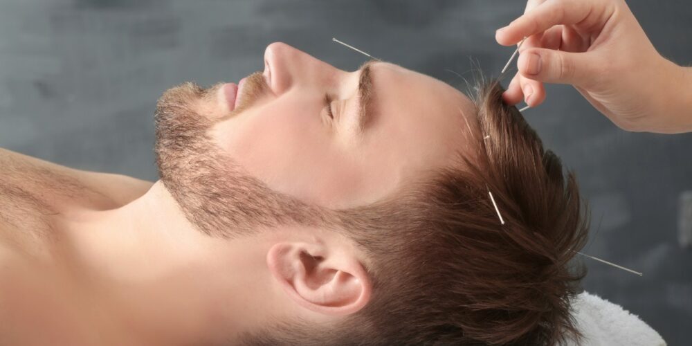 La acupuntura podría mejorar la memoria