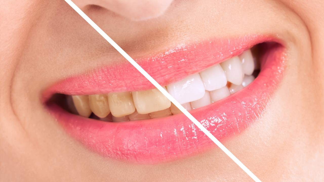¿Qué causa las manchas en los dientes?