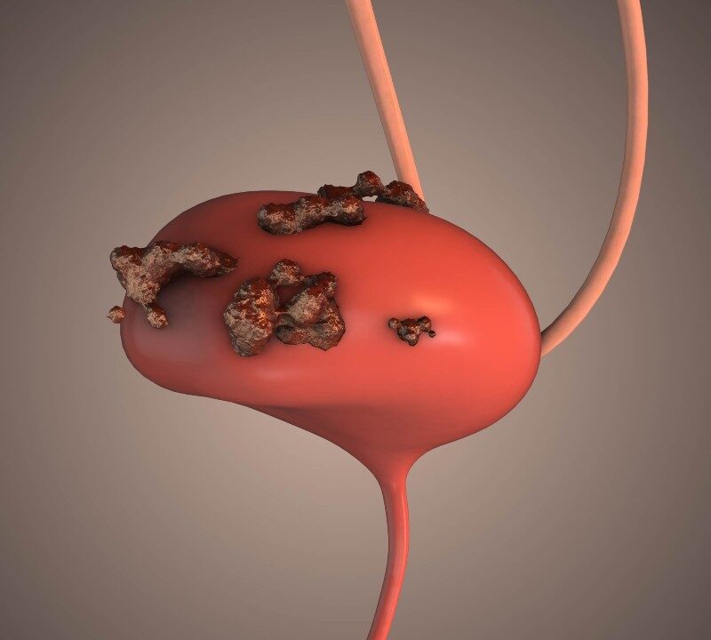 Cáncer de la vejiga: síntomas y factores de riesgo