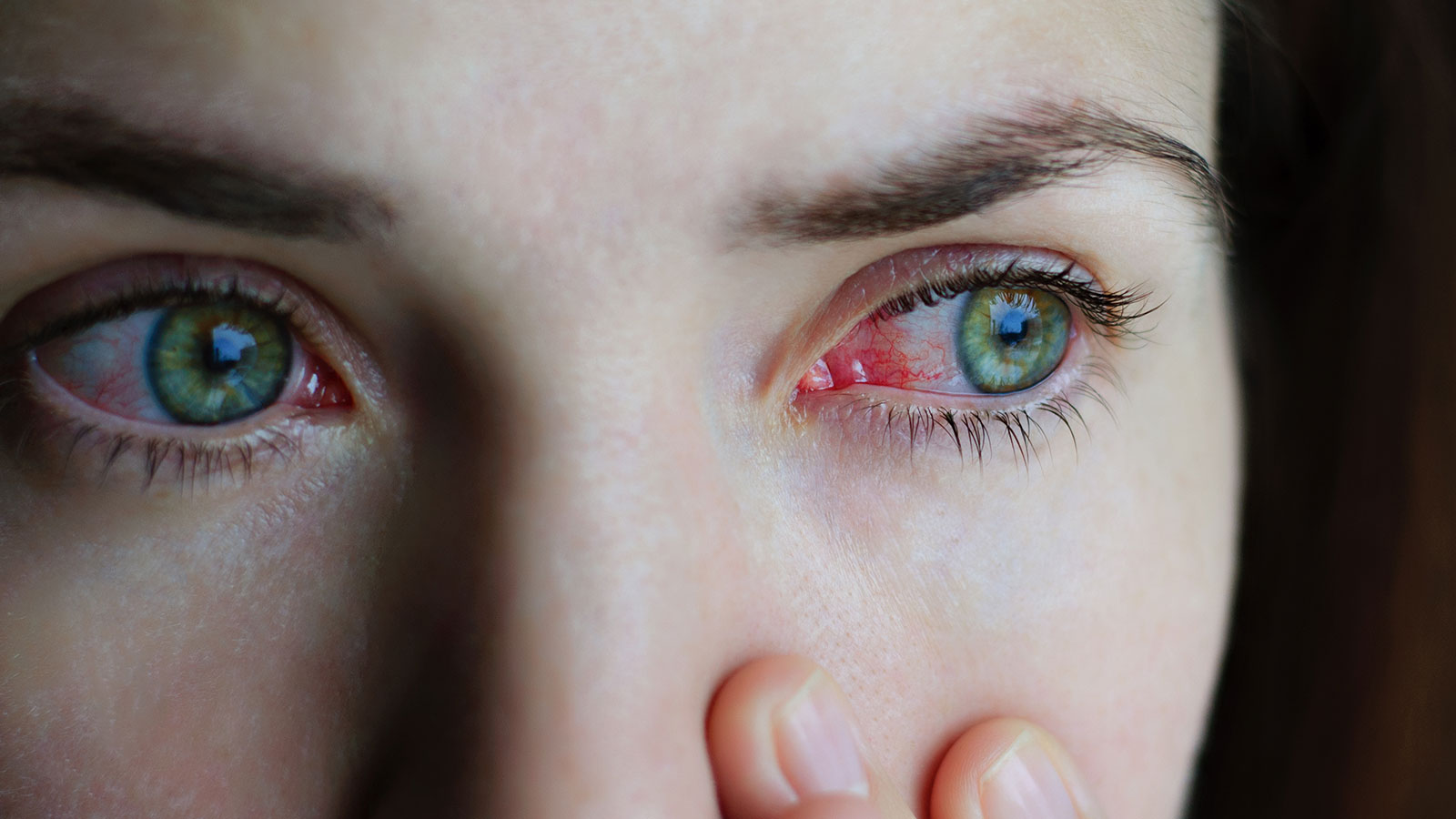 ¿Qué es la conjuntivitis u ojo rojo?