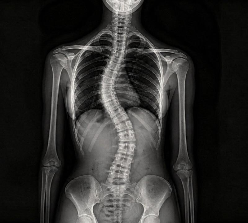 Escoliosis tras la menopausia: señales y factores de riesgo