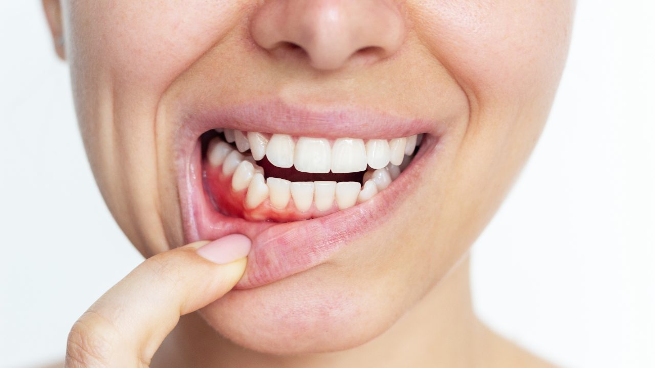 Gingivitis: la inflamación de las encías
