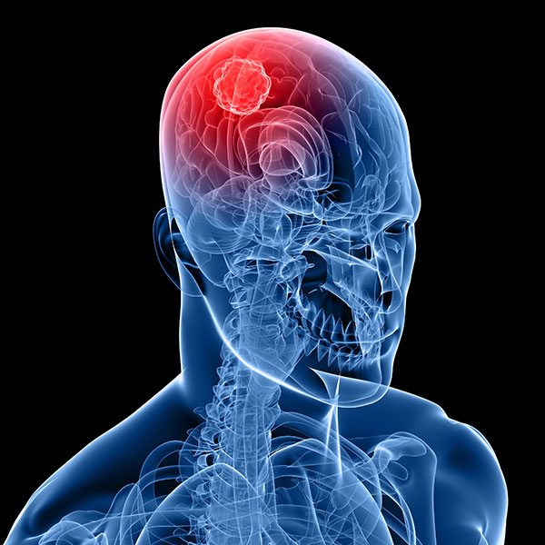 Cáncer cerebral: ¿qué es el cáncer en el cerebro y cómo se identifica?