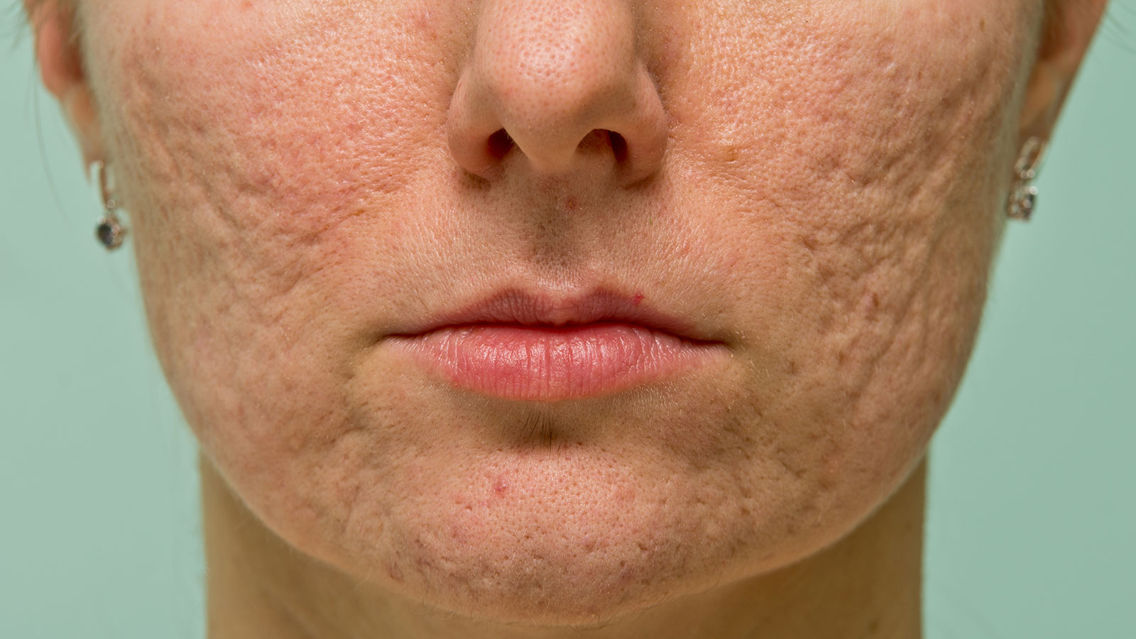 Cicatrices de acné: la huella de la adolescencia