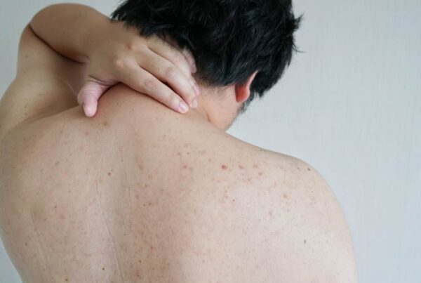 10 consejos para aliviar el acné en el cuerpo