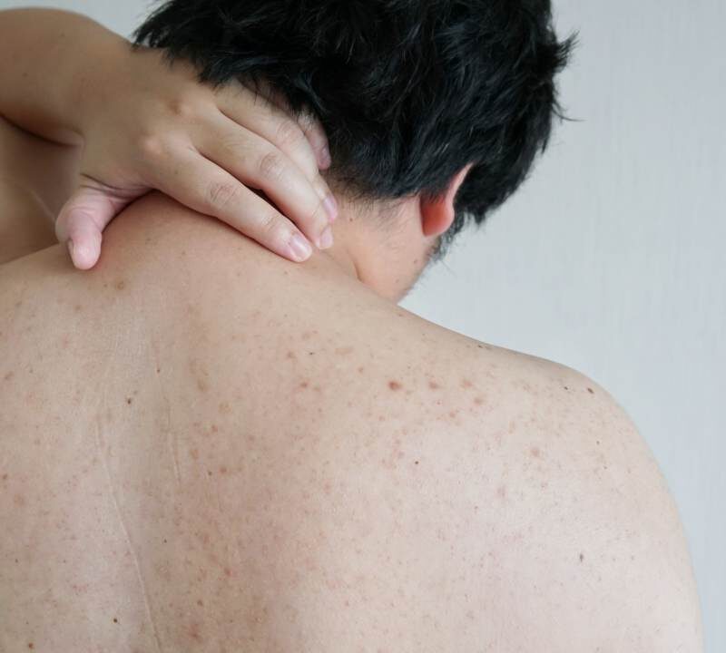 10 consejos para aliviar el acné en el cuerpo