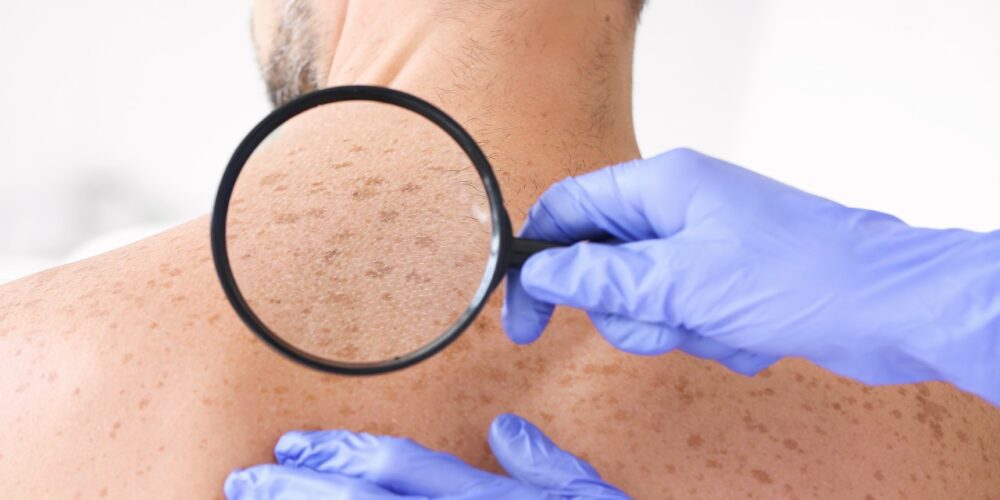 Las lesiones benignas de la piel frecuentes y sus signos de alerta