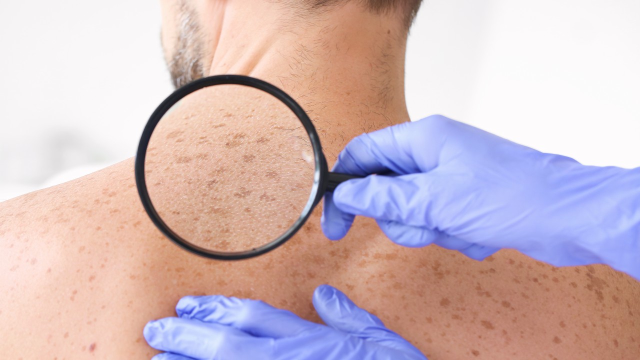 Las lesiones benignas de la piel frecuentes y sus signos de alerta