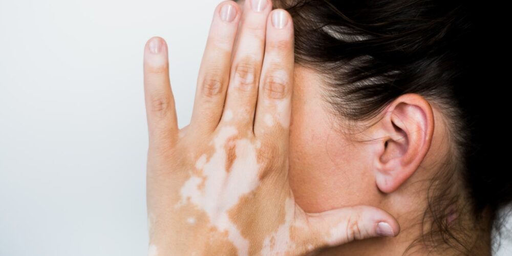El vitiligo, una enfermedad aún muy desconocida y estigmatizante