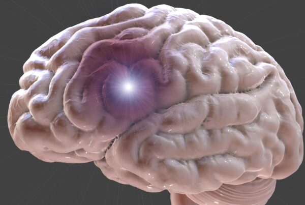 Aprende a reconocer los síntomas de una embolia cerebral