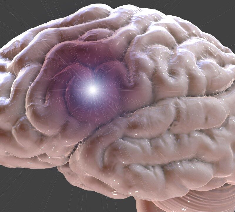 Aprende a reconocer los síntomas de una embolia cerebral