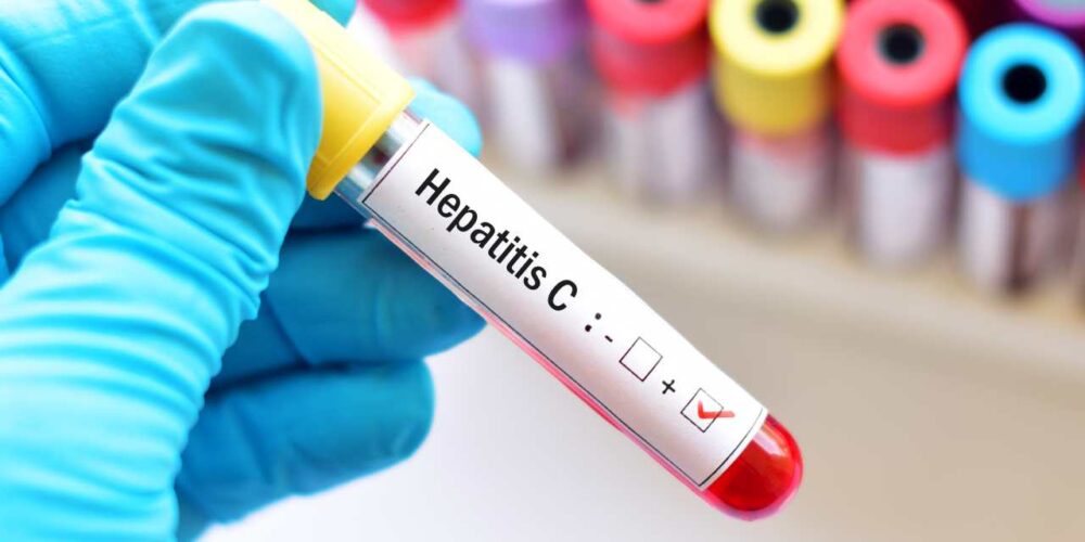 La hepatitis C puede pasar desapercibida, atento a estos síntomas