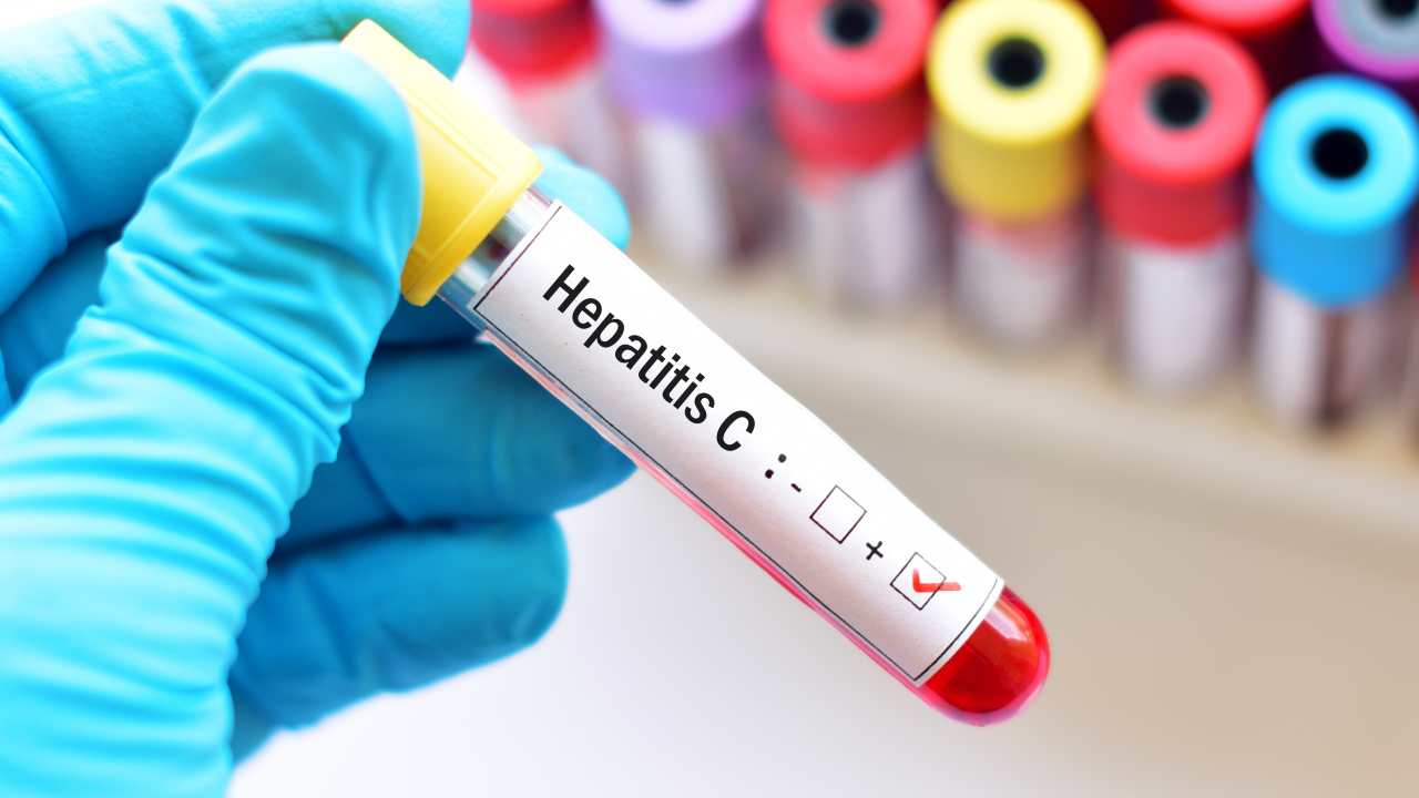 La hepatitis C puede pasar desapercibida, atento a estos síntomas