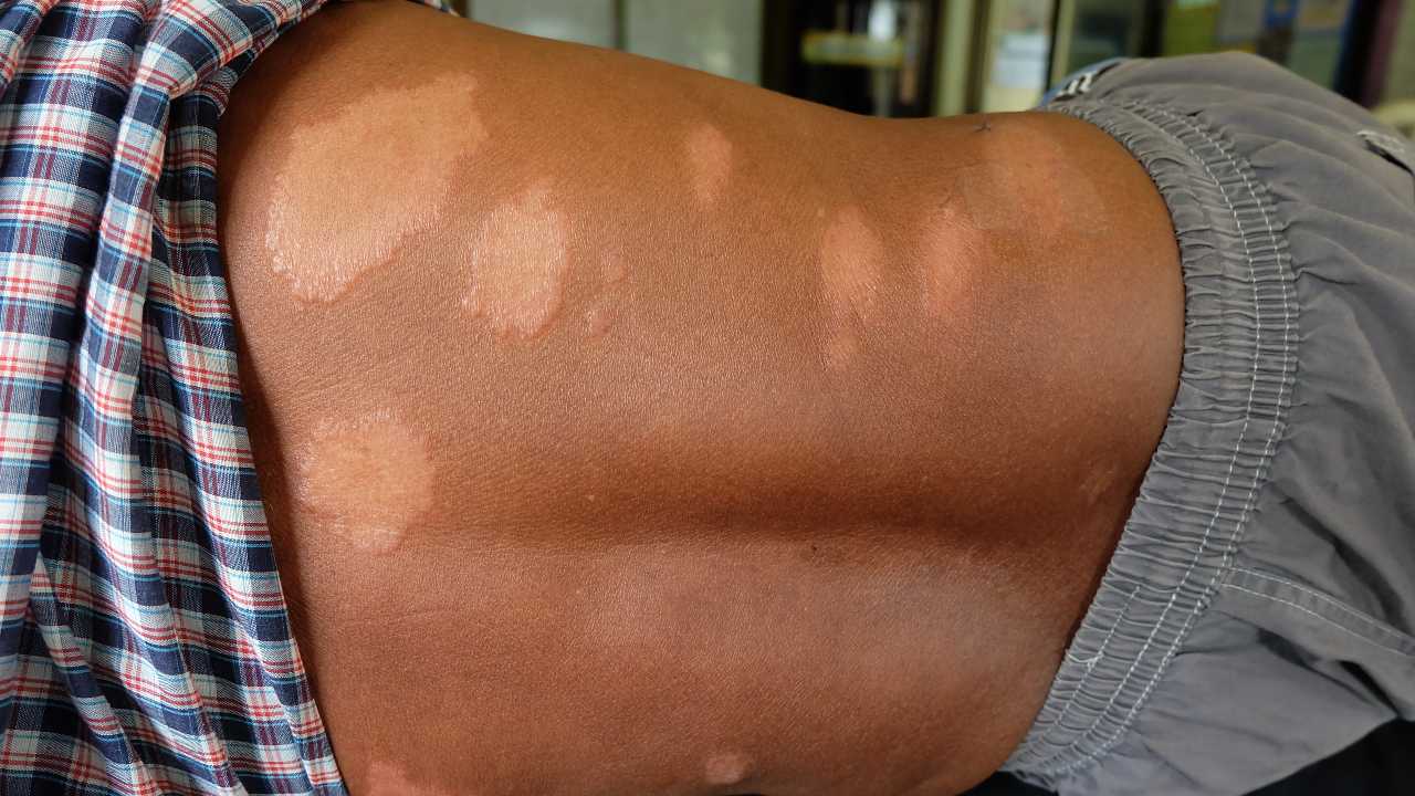 Conoce sobre la lepra: una enfermedad antigua pero vigente