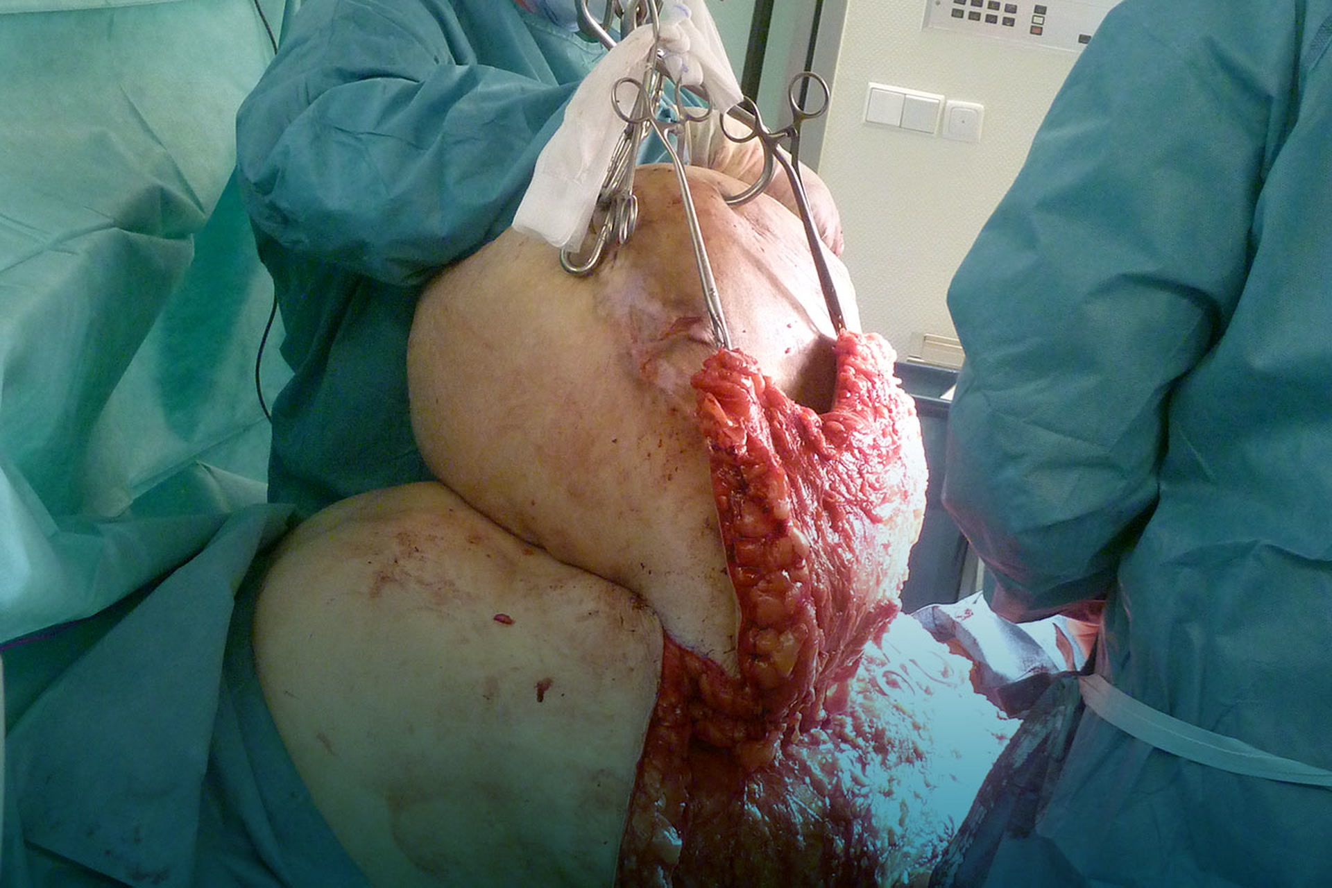 Cirugía bariátrica, un testimonio de vida