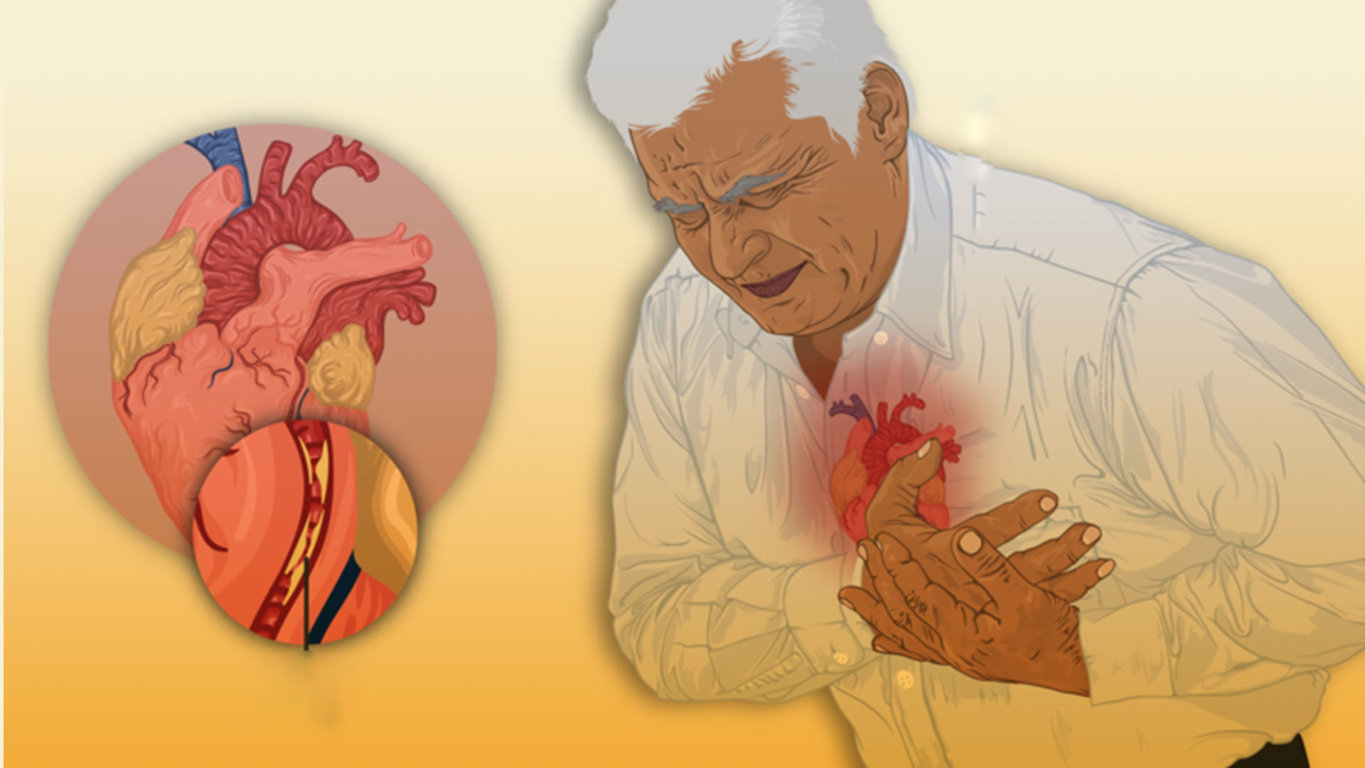 ¿Cómo identificar un infarto en un adulto mayor?