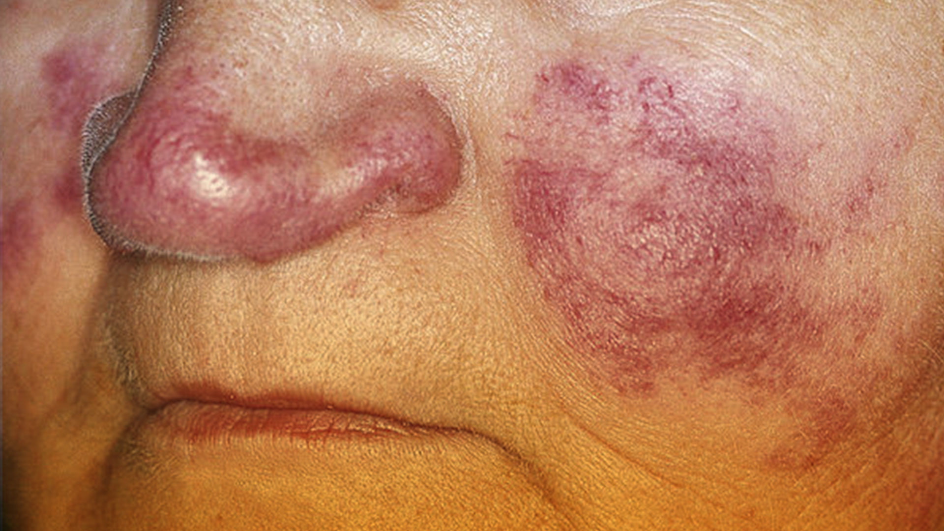 ¿Qué es el lupus eritematoso sistémico?