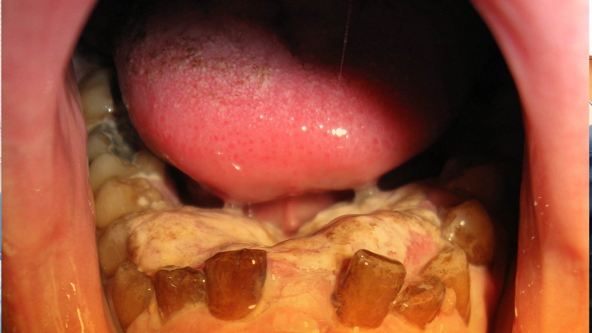 Cáncer de orofaringe y de cavidad oral