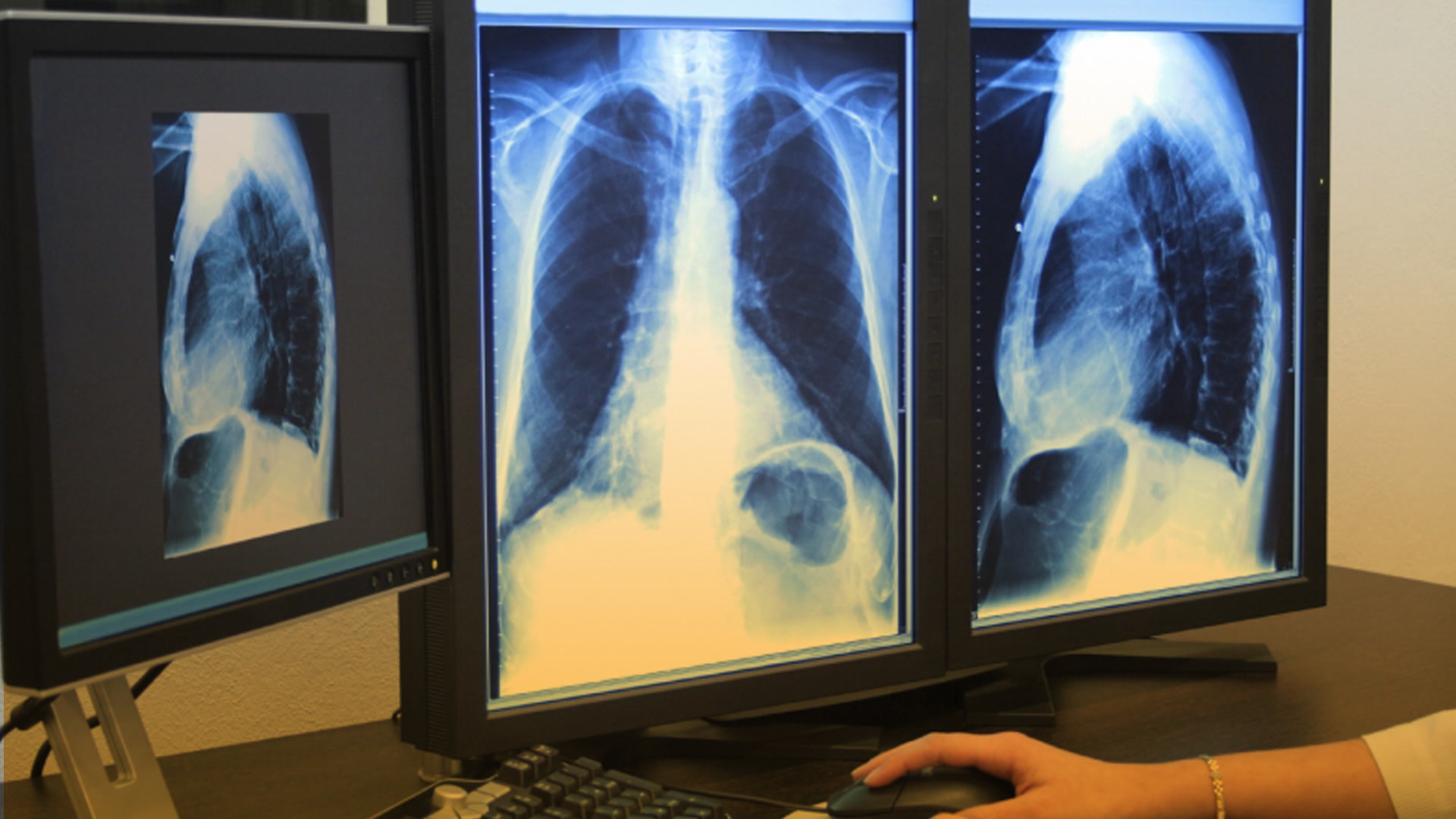 Prevenciones médicas y colaboración para realizar menos radiografías