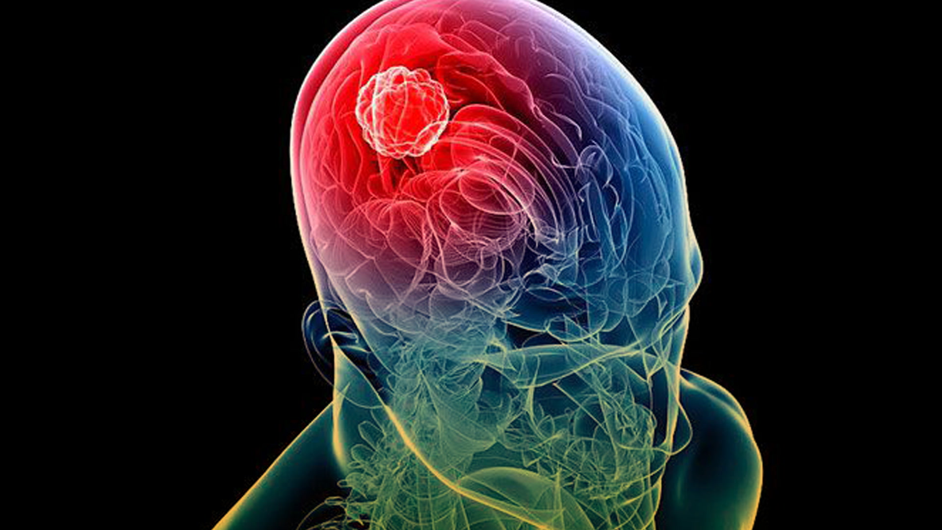 Sistema de mapeo de realidad virtual facilita extraer tumores de cerebros con hemorragia cerebral