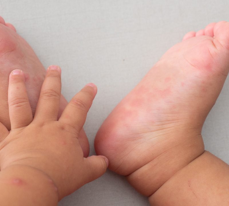 Enfermedad de las manos, pies y boca: ¿qué es?