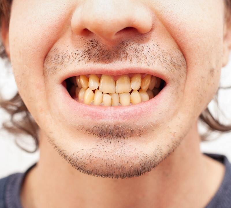 ¿Existe una conexión entre los dientes amarillos y los antibióticos?