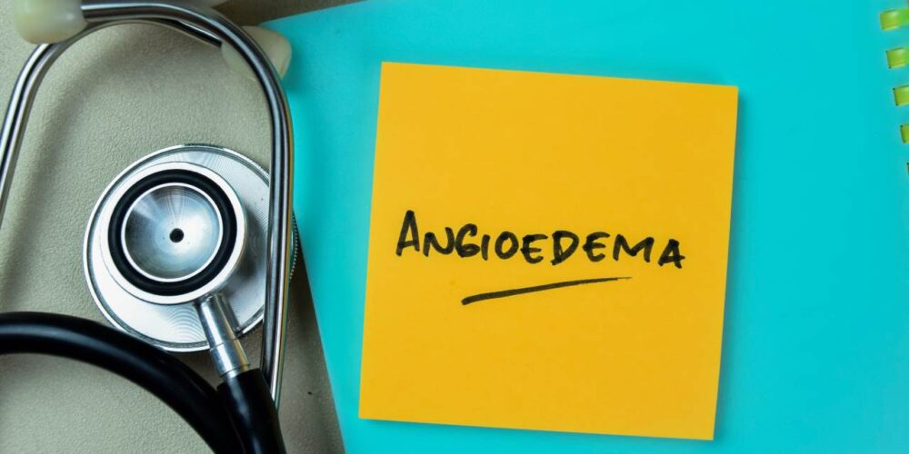 Diferencias entre el angioedema hereditario y el adquirido