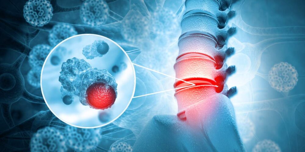 Tumores del canal medular: síntomas, tipos y tratamientos