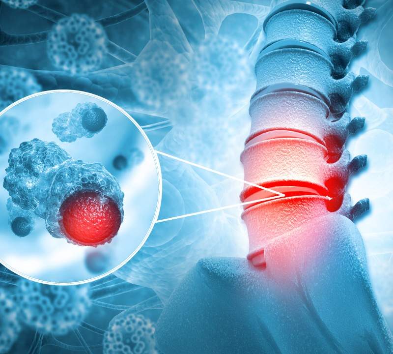 Tumores del canal medular: síntomas, tipos y tratamientos