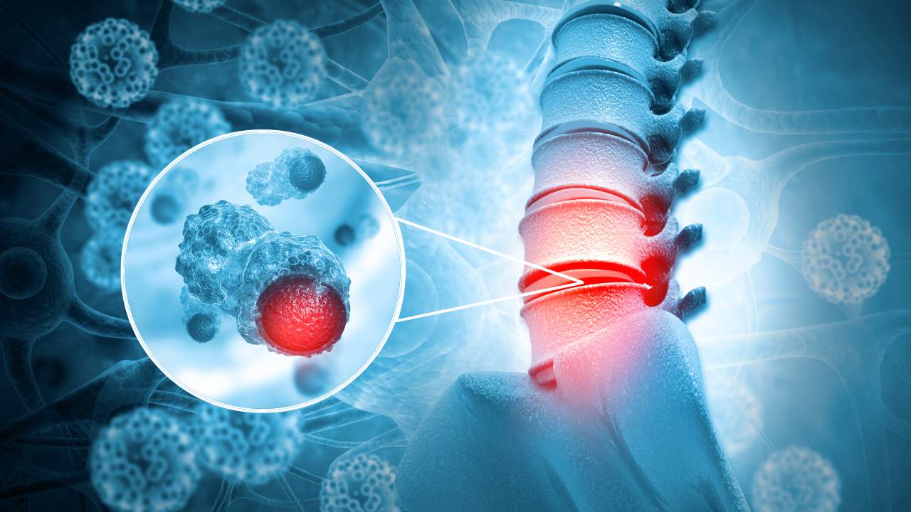 Tumores del canal medular: síntomas, tipos y tratamientos