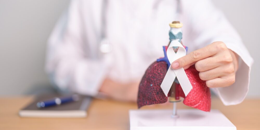 Gráfico sobre la incidencia del adenocarcinoma de pulmón a nivel mundial.