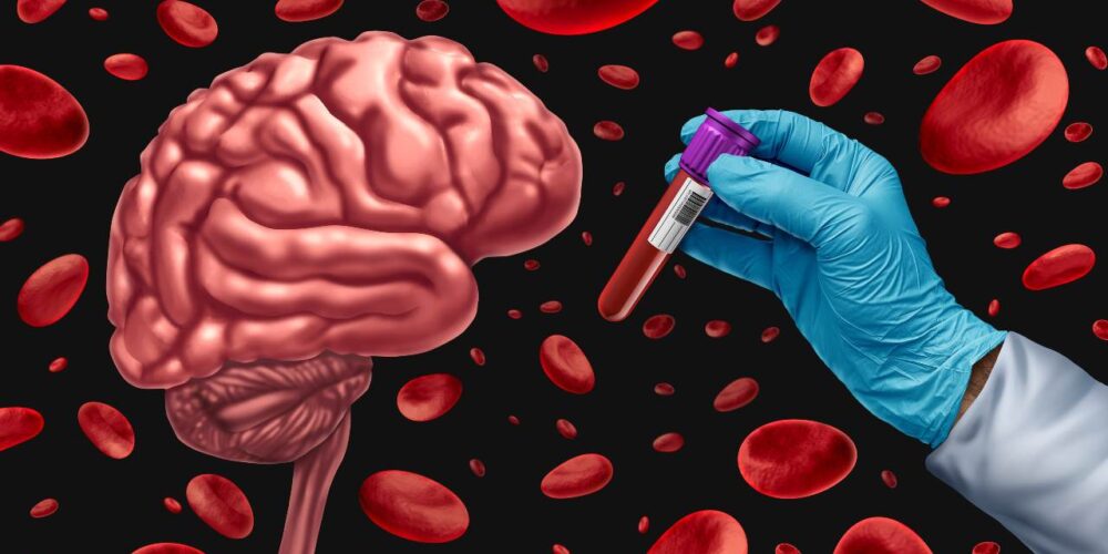 análisis de sangre Alzheimer