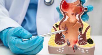 Hemorroides: claves para entender y tratar esta condición común