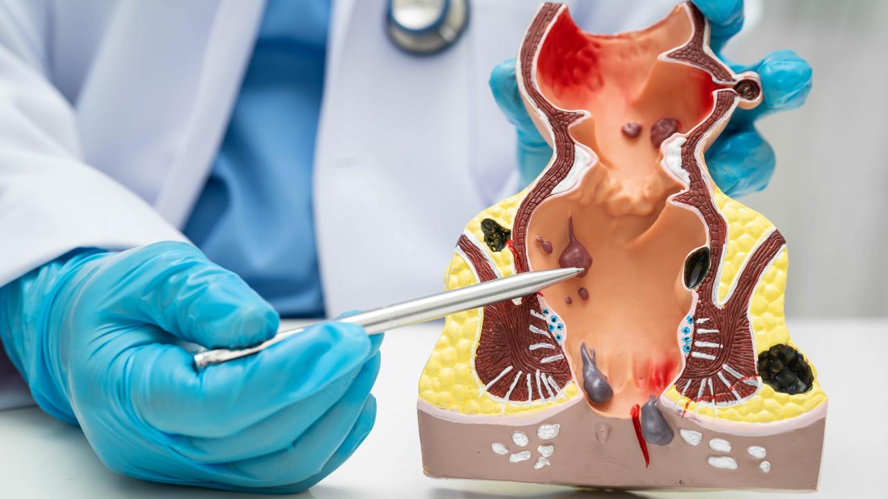Hemorroides: claves para entender y tratar esta condición común