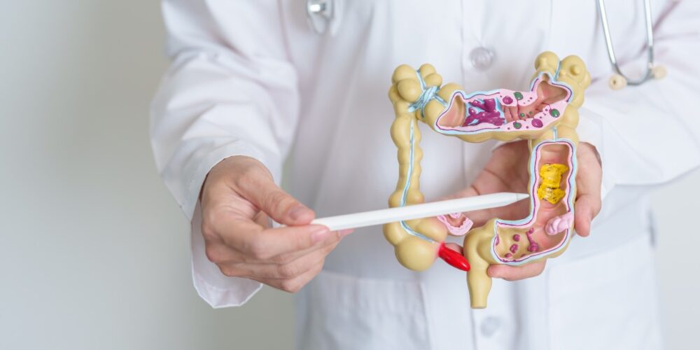 ¿Diverticulosis es lo mismo que diverticulitis? explicación médica