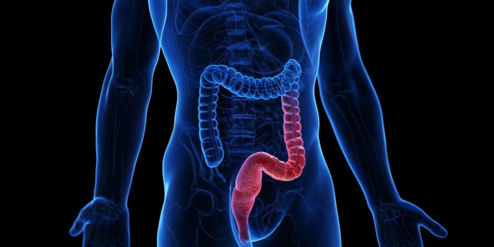 Colitis ulcerosa enfermedad inflamatoria intestinal que afecta el intestino grueso