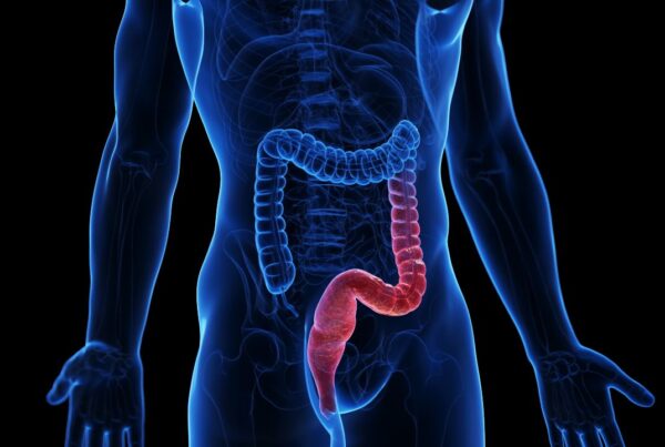 Colitis ulcerosa enfermedad inflamatoria intestinal que afecta el intestino grueso