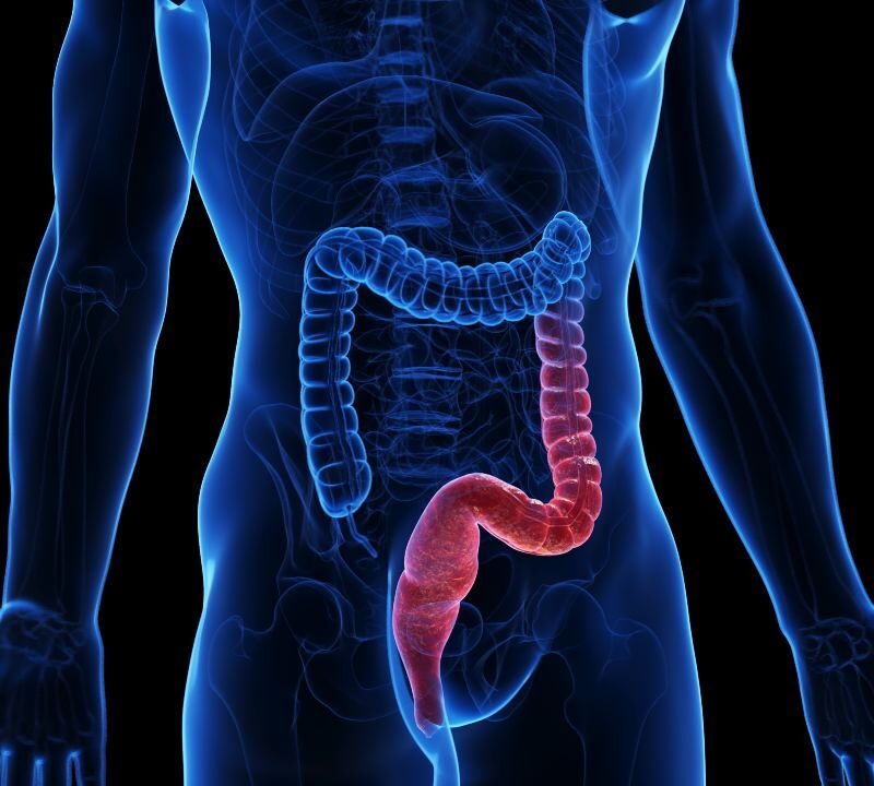 Colitis ulcerosa enfermedad inflamatoria intestinal que afecta el intestino grueso