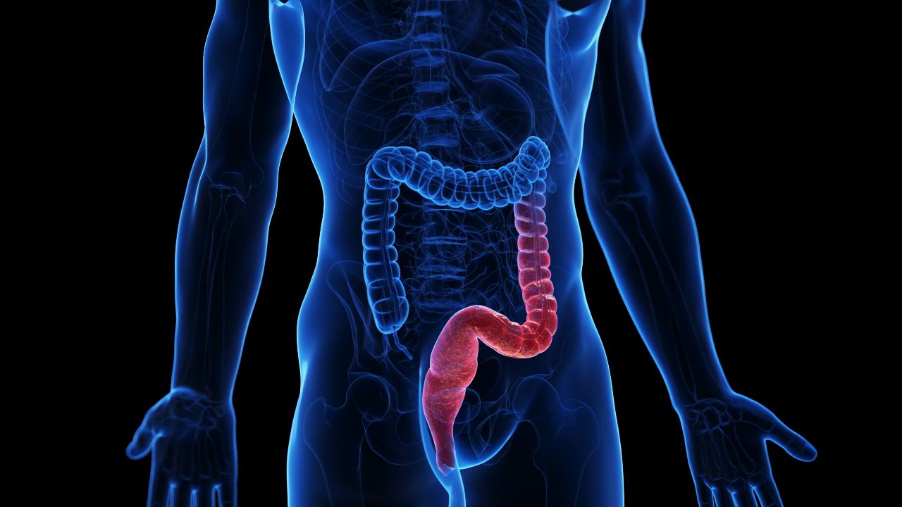 Colitis ulcerosa: 7 datos impactantes que debes conocer