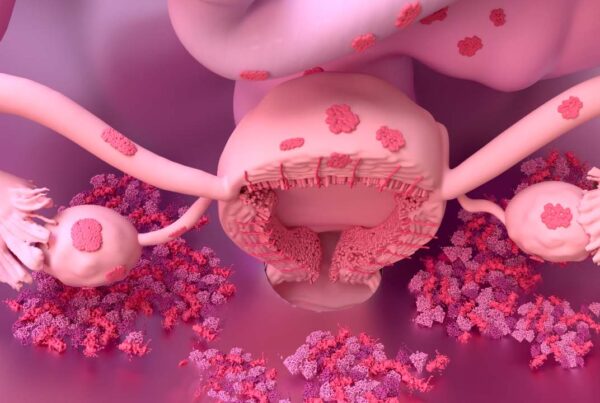 ilustración médica sobre endometriosis y sus síntomas
