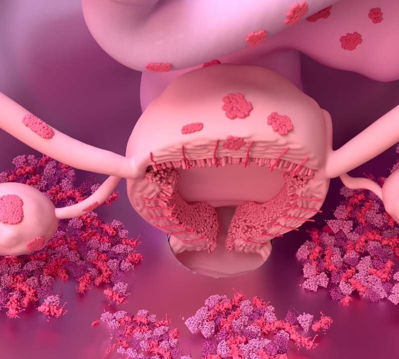 ilustración médica sobre endometriosis y sus síntomas