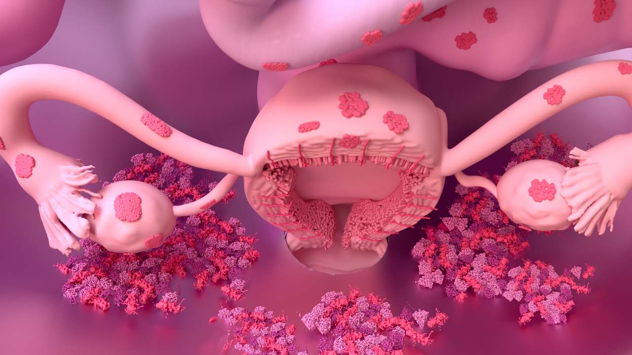 Mitos y realidades de la endometriosis: lo que nadie te cuenta