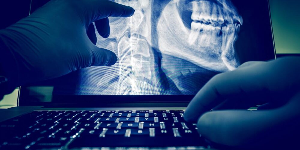 Radiografía mostrando cáncer de la pulpa dental en etapa inicial