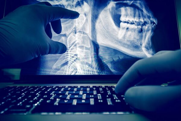 Radiografía mostrando cáncer de la pulpa dental en etapa inicial