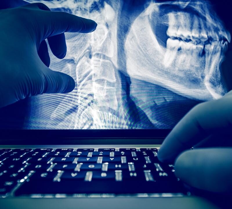 Radiografía mostrando cáncer de la pulpa dental en etapa inicial