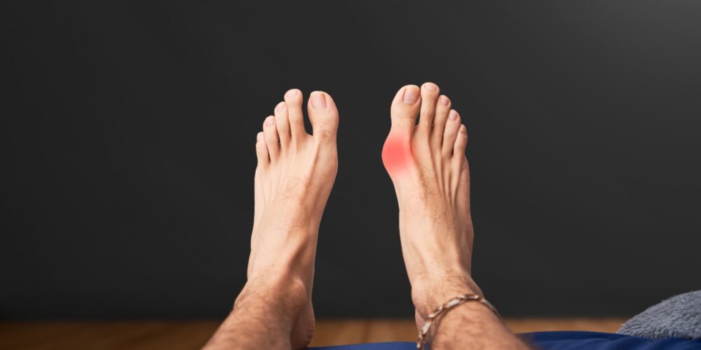 pie con juanetes y callos tratados en consulta médica